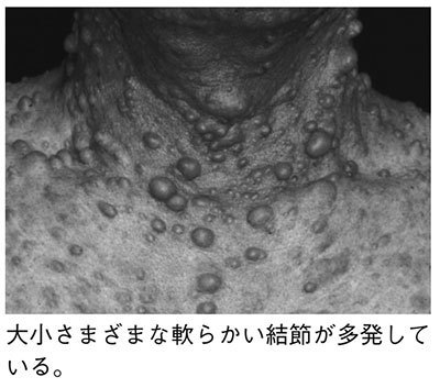 ザ 世界仰天ニュース 2時間sp 顔面腫瘍で変形する病気って 3 29日本テレビ 気になる話題をちょこちょこブログ